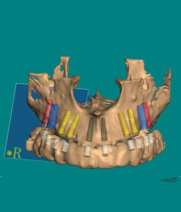 3D-Implantatplanung