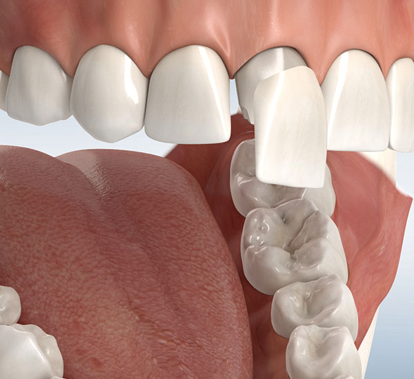 Veneers (Verblendschalen)