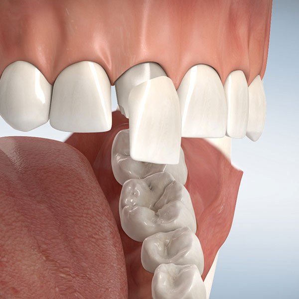 droessler-veneers